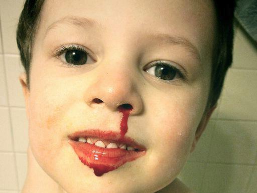 Por que a criança tem sangue no nariz? Causas de sangramento do nariz, tratamento