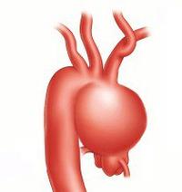 Aneurisma da aorta da cavidade abdominal: causas, sintomas e tratamento