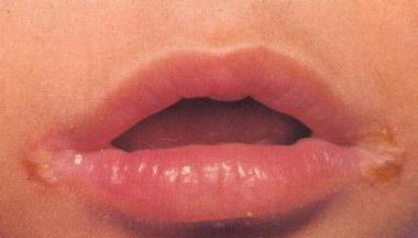 Halit nos lábios: tipos, causas e tratamento