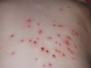 Molusco contagioso em uma criança, tratamento de pele