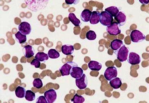 O que é leucemia? 