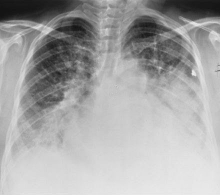 Causas de edema pulmonar e tratamento primário desta condição patológica